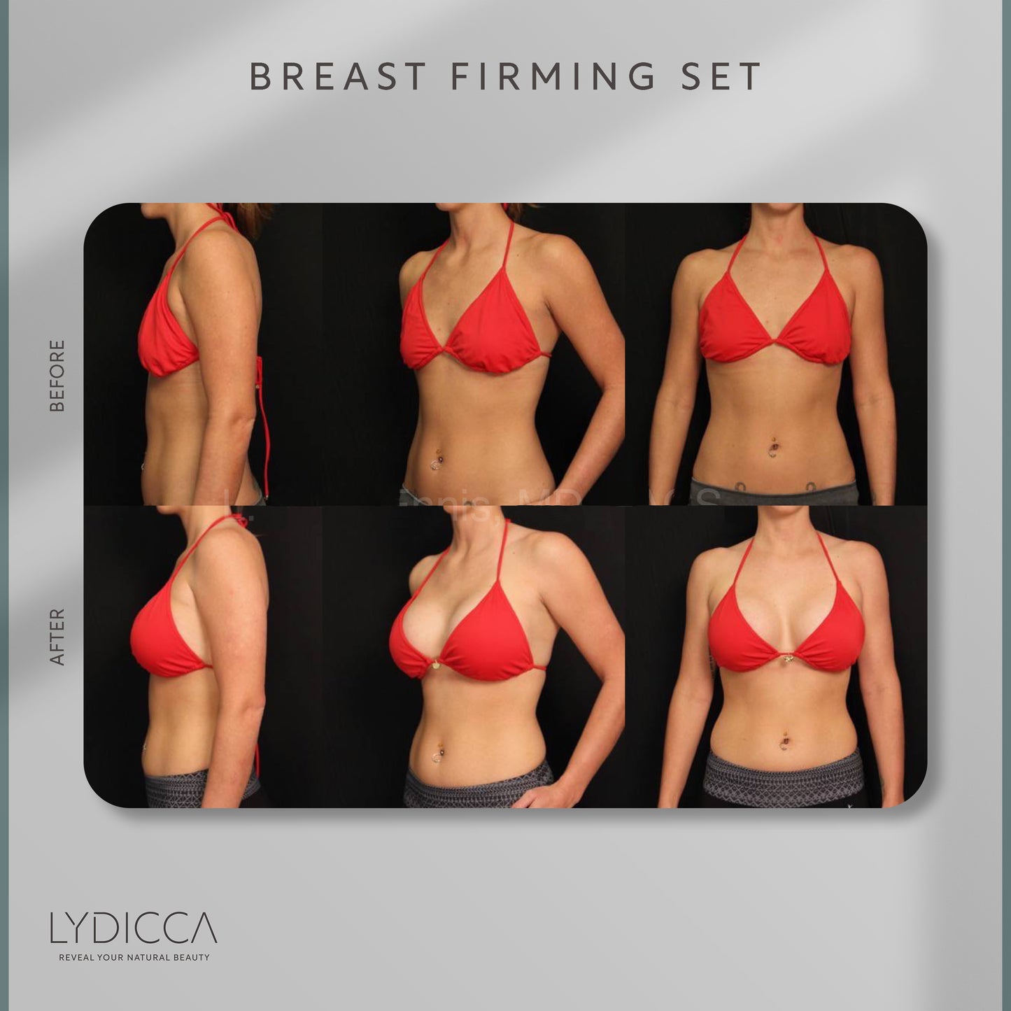 Набор для укрепления груди – Lydicca